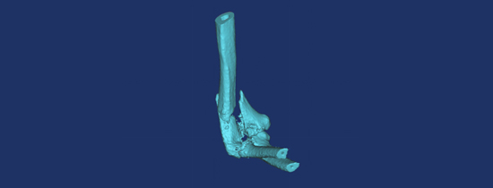 3D打印模型，帮助肘关节粉碎性骨折复位