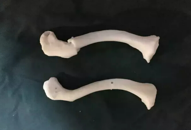 3D打印“镜像”模型辅助设计下微创治疗锁骨骨折