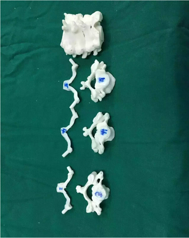 3D打印置钉导板辅助下完成下颈椎椎弓根螺固定手术